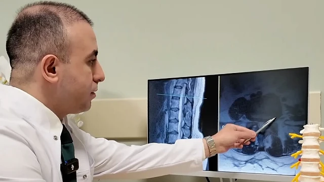 Bel Fıtığı Tedavisinde Ameliyatın Gerekliliği Üzerine Bilgilendirmeler